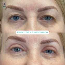 Plastyka chirurgiczna powiek górnych przed i po zabiegu