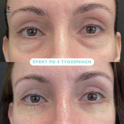 Plastyka chirurgiczna powiek górnych przed i po zabiegu