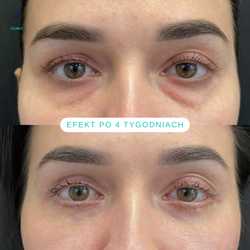 Plastyka chirurgiczna powiek górnych przed i po zabiegu