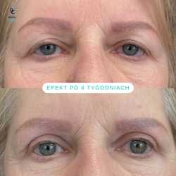 Plastyka chirurgiczna powiek górnych przed i po zabiegu