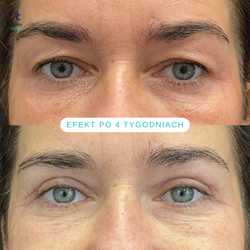 Plastyka chirurgiczna powiek górnych przed i po zabiegu