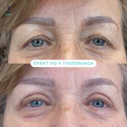 Plastyka chirurgiczna powiek górnych przed i po zabiegu
