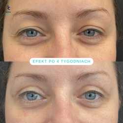 Plastyka chirurgiczna powiek górnych przed i po zabiegu