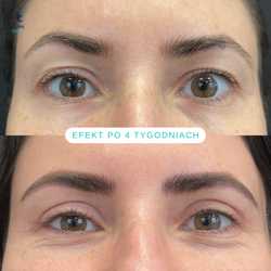 Plastyka chirurgiczna powiek górnych przed i po zabiegu