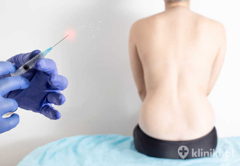 Polega na podaniu środka znieczulającego do przestrzeni nadoponowej kręgosłupa