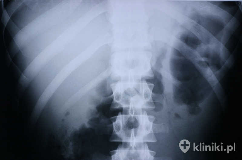 Zdjęcie rentgenowskie kręgosłupa