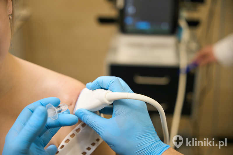 Artroskopia stawu barkowego wiąże się z mniejszym bólem pooperacyjnym