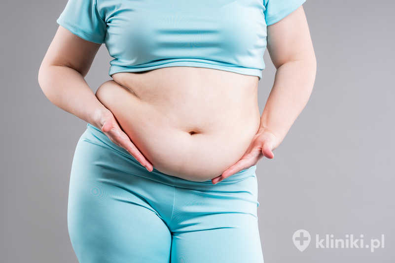 Efekty operacji plastycznej brzucha są trwałe, ale zależą od stylu życia pacjenta Efekty operacji plastycznej brzucha są trwałe, ale zależą od stylu życia pacjenta