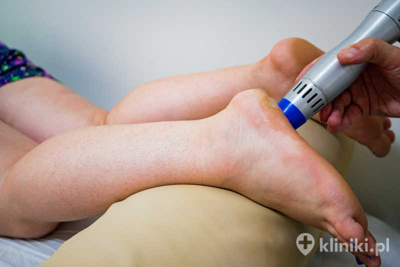 Fala uderzeniowa w leczeniu ostrogi piętowej poprawia ukrwienie i przyspiesza gojenie tkanek