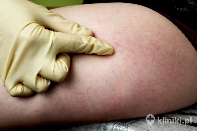 Laseroterapia naczynek na nogach prowadzi do zamknięcia i stopniowego zaniku zmian
