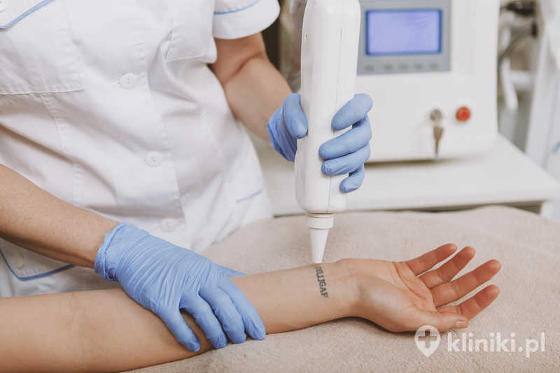 Laseroterapia tatuażu wymaga zwykle kilku sesji dla uzyskania satysfakcjonującego efektu Laseroterapia tatuażu wymaga zwykle kilku sesji dla uzyskania satysfakcjonującego efektu