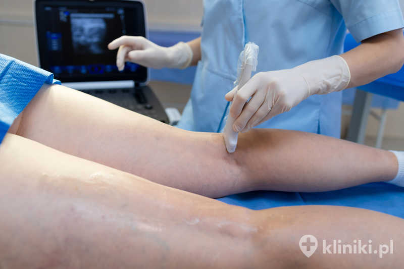 Laserowe usuwanie pajączków na nogach jest zabiegiem małoinwazyjnym