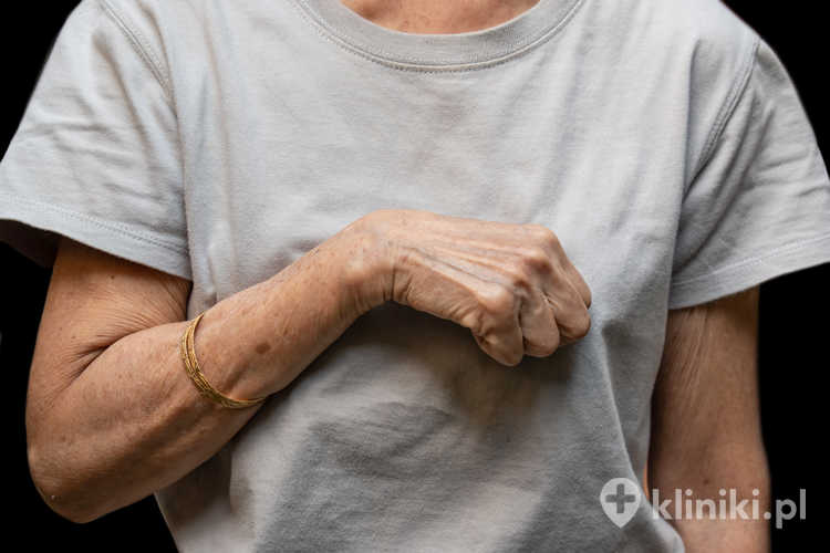 Leczenie przykurczu Dupuytrena