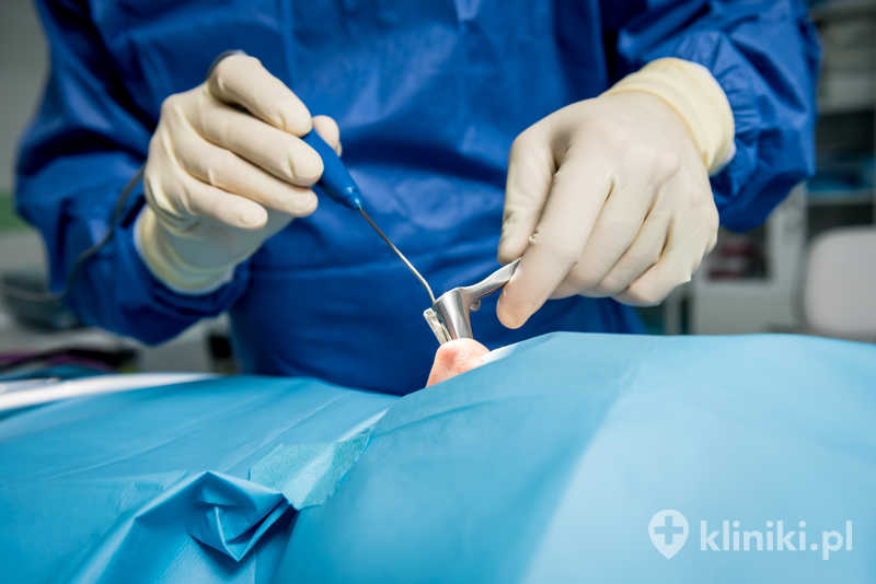 Operacja endoskopowa zatok przynosowych FESS/FEOZ to małoinwazyjny zabieg wykonywany przez jamę nosa