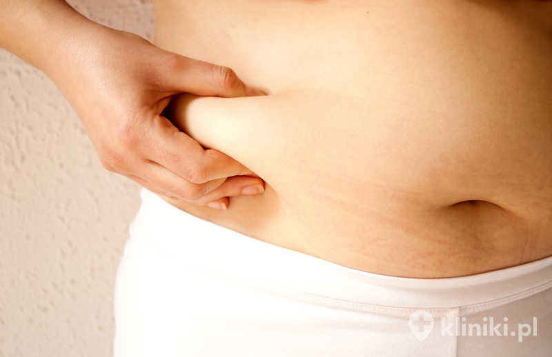 Plastyka brzucha (abdominoplastyka) często obejmuje także napięcie mięśni ściany brzucha Plastyka brzucha (abdominoplastyka) często obejmuje także napięcie mięśni ściany brzucha