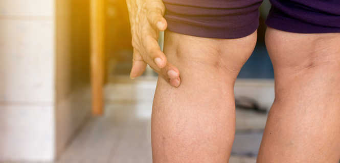 Skleroterapia - najlepszy okres na wykonanie zabiegu