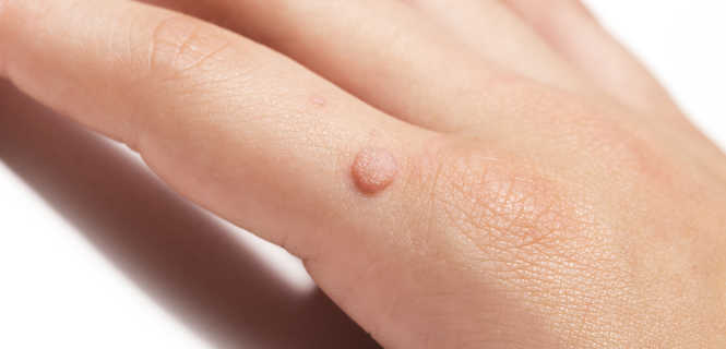 Usunięcie brodawki wirusowej / kurzajki