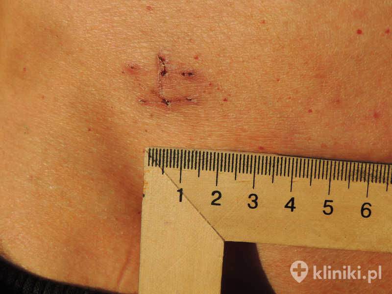 Usunięcie torbieli jajnika laparoskopowo to małoinwazyjny zabieg chirurgiczny wykonywany przez niewielkie nacięcia