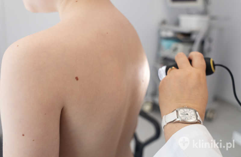 Usunięcie znamienia barwnikowego najczęściej polega na jego chirurgicznym wycięciu