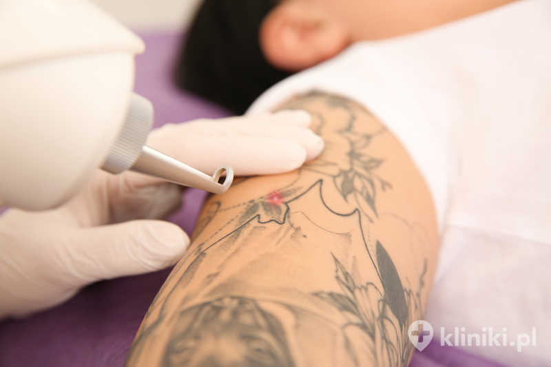 Usuwanie tatuażu laserem umożliwia stopniowe rozjaśnianie wzoru Usuwanie tatuażu laserem umożliwia stopniowe rozjaśnianie wzoru