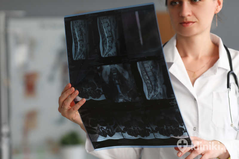 Zabieg usunięcia dysku w odcinku lędźwiowym przeprowadza się zwykle po nieskutecznym leczeniu zachowawczym