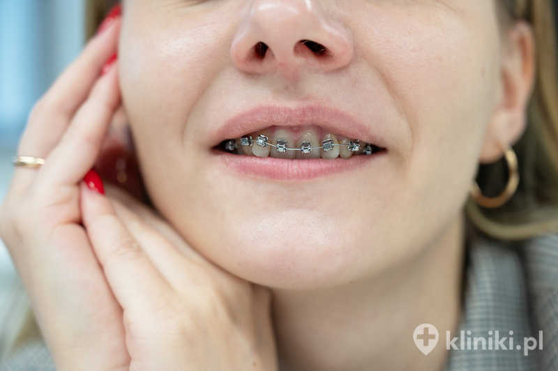 Aparat samoligaturujący Damon może poprawiać komfort pacjenta dzięki zastosowaniu delikatniejszych sił ortodontycznych Aparat samoligaturujący Damon może poprawiać komfort pacjenta dzięki zastosowaniu delikatniejszych sił ortodontycznych