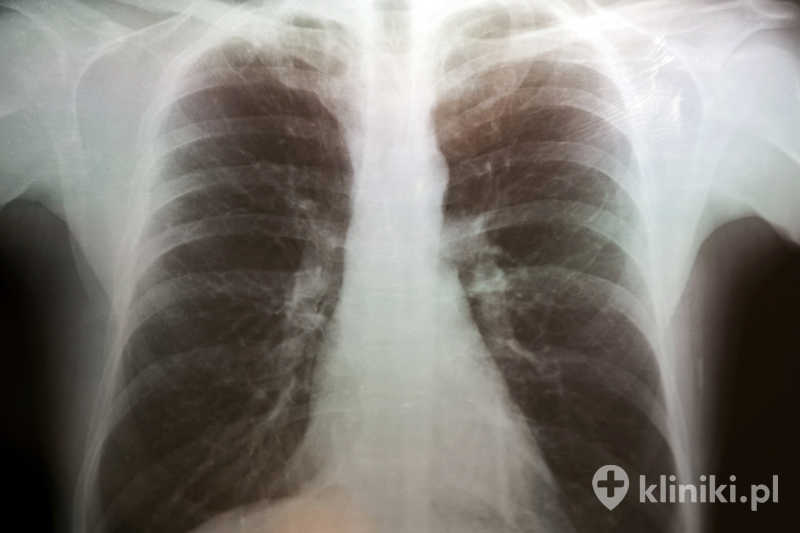 Badanie MRI klatki piersiowej pomaga w diagnostyce zmian nowotworowych, chorób śródpiersia oraz wybranych schorzeń naczyń Badanie MRI klatki piersiowej pomaga w diagnostyce zmian nowotworowych, chorób śródpiersia oraz wybranych schorzeń naczyń