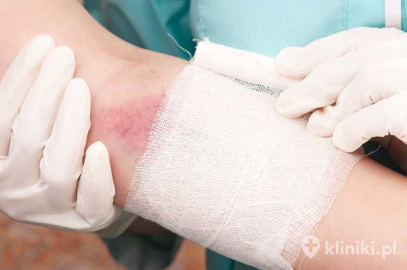 Bandażowanie ręki po zabiegu RFITT Bandażowanie ręki po zabiegu RFITT