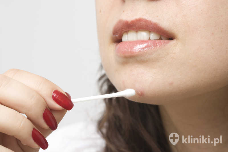 Blemiderm – zabieg Mesoestetic wspiera redukcję zmian trądzikowych i nadmiernego wydzielania sebum Blemiderm – zabieg Mesoestetic wspiera redukcję zmian trądzikowych i nadmiernego wydzielania sebum