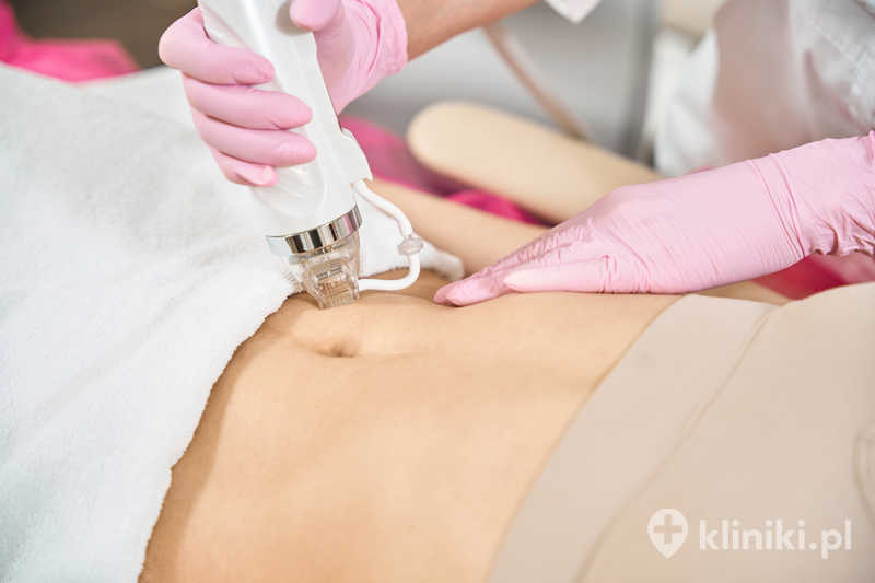 Estetyk wykonujący mikroigłowanie częstotliwością radiową w okolicy brzucha pacjenta Estetyk wykonujący mikroigłowanie częstotliwością radiową w okolicy brzucha pacjenta