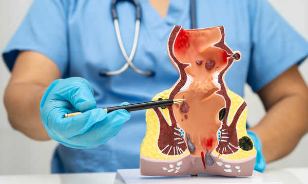 Hemoroidy widoczne na modelu anatomicznym odbytu Hemoroidy widoczne na modelu anatomicznym odbytu