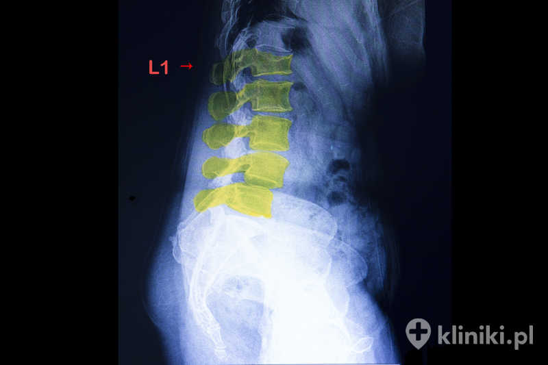 Małoinwazyjna stentoplastyka kręgu wykonywana jest pod kontrolą obrazowania radiologicznego