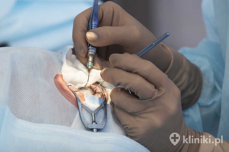Operacja zaćmy metodą fakoemulsyfikacji z wszczepieniem soczewki asferycznej pozwala usunąć zmętniałą soczewkę i poprawić jakość widzenia Operacja zaćmy metodą fakoemulsyfikacji z wszczepieniem soczewki asferycznej pozwala usunąć zmętniałą soczewkę i poprawić jakość widzenia