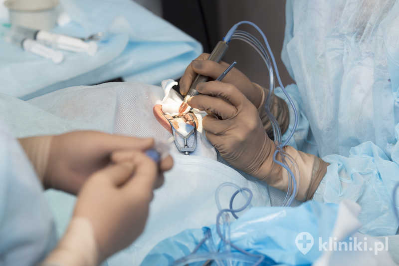 Operacja zaćmy metodą fakoemulsyfikacji z wszczepieniem soczewki multifokalnej torycznej poprawia widzenie na różne odległości Operacja zaćmy metodą fakoemulsyfikacji z wszczepieniem soczewki multifokalnej torycznej poprawia widzenie na różne odległości