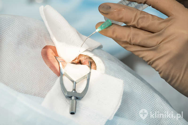 Operacja zaćmy metodą fakoemulsyfikacji z wszczepieniem soczewki sferycznej z filtrem światła niebieskiego pozwala usunąć zmętniałą soczewkę i poprawić ostrość widzenia Operacja zaćmy metodą fakoemulsyfikacji z wszczepieniem soczewki sferycznej z filtrem światła niebieskiego pozwala usunąć zmętniałą soczewkę i poprawić ostrość widzenia