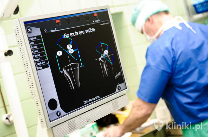 Osteotomia stawu kolanowego pozwala skorygować nieprawidłową oś kończyny i zmniejszyć przeciążenia w stawie Osteotomia stawu kolanowego pozwala skorygować nieprawidłową oś kończyny i zmniejszyć przeciążenia w stawie