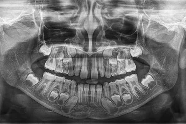 Pantomogram