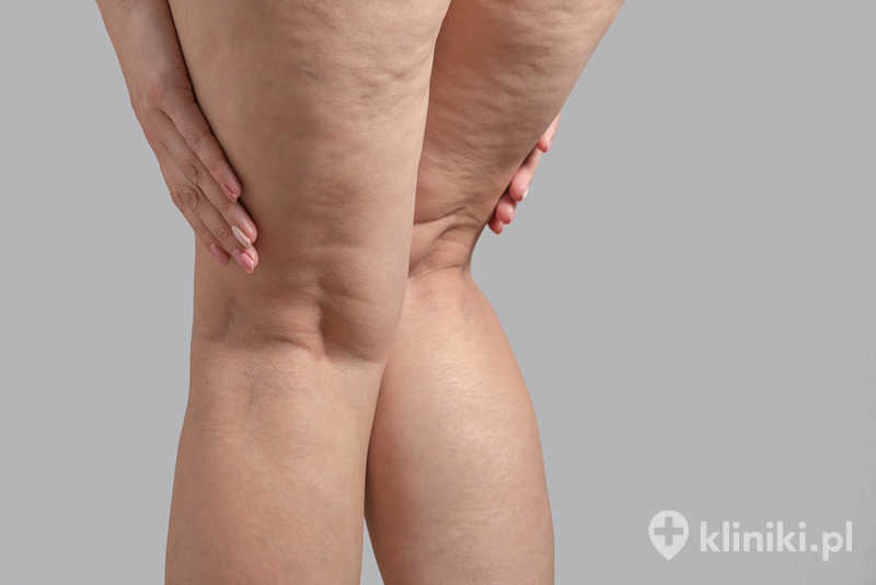 Rozstępy, cellulit i żylaki na kobiecych nogach