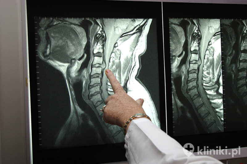 Tomografia komputerowa kręgosłupa szyjnego to badanie obrazowe umożliwiające szczegółową ocenę kręgów szyjnych oraz otaczających je struktur anatomicznych Tomografia komputerowa kręgosłupa szyjnego to badanie obrazowe umożliwiające szczegółową ocenę kręgów szyjnych oraz otaczających je struktur anatomicznych