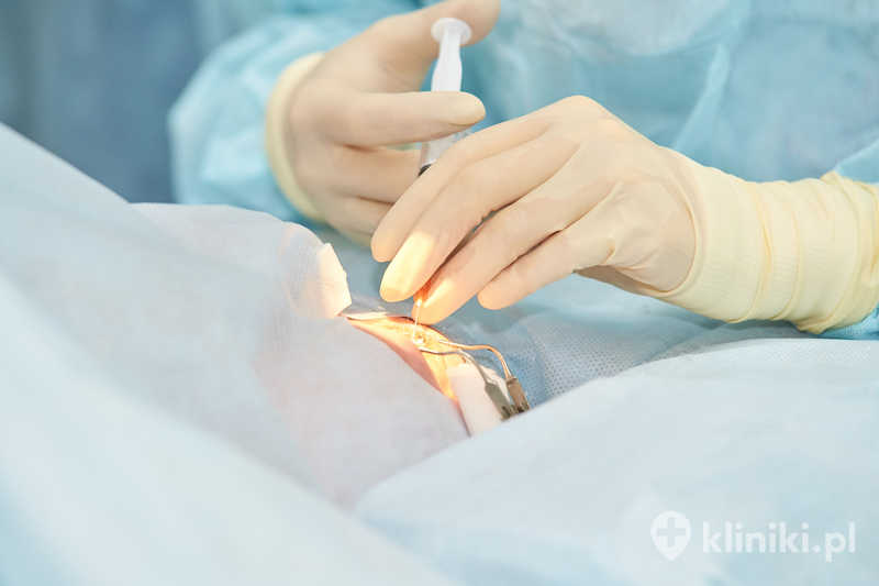 Zabieg fakoemulsyfikacji z implantacją soczewki asferycznej z filtrem światła niebieskiego jest wykonywany przez niewielkie nacięcie rogówki Zabieg fakoemulsyfikacji z implantacją soczewki asferycznej z filtrem światła niebieskiego jest wykonywany przez niewielkie nacięcie rogówki