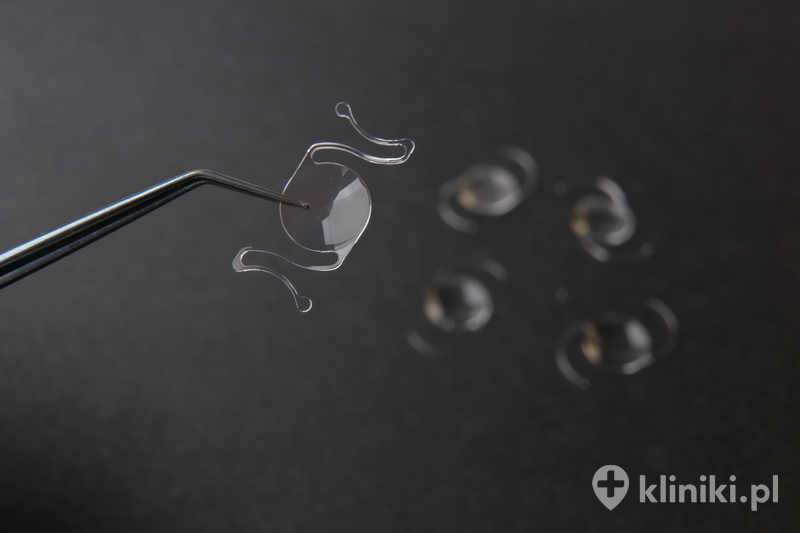 Zabieg usunięcia zaćmy metodą fakoemulsyfikacji z implantacją soczewki asferycznej jest wykonywany przez niewielkie nacięcie rogówki Zabieg usunięcia zaćmy metodą fakoemulsyfikacji z implantacją soczewki asferycznej jest wykonywany przez niewielkie nacięcie rogówki