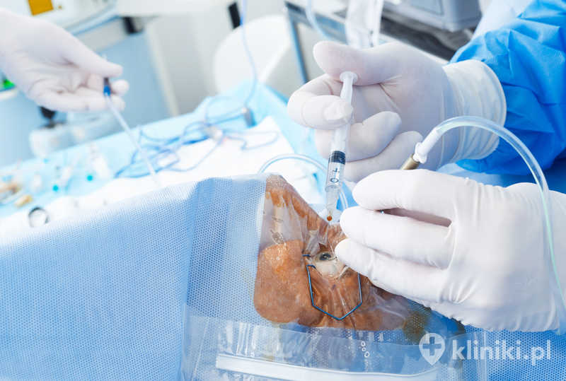Zabieg usunięcia zaćmy z implantacją soczewki EDOF jest wykonywany przy użyciu nowoczesnych technik mikrochirurgicznych Zabieg usunięcia zaćmy z implantacją soczewki EDOF jest wykonywany przy użyciu nowoczesnych technik mikrochirurgicznych