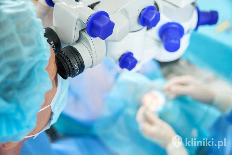 Zabieg usunięcia zaćmy z implantacją soczewki sferycznej wyposażonej w filtr światła niebieskiego wykonywany jest przez niewielkie nacięcie rogówki Zabieg usunięcia zaćmy z implantacją soczewki sferycznej wyposażonej w filtr światła niebieskiego wykonywany jest przez niewielkie nacięcie rogówki