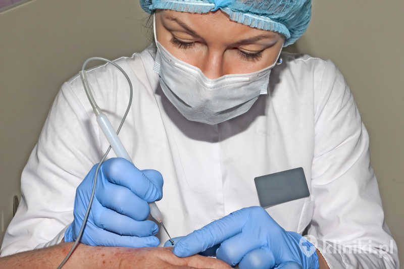 Dermatolog-chirurg usuwa zmiany skórne za pomocą elektrokoagulatora w swoim gabinecie zabiegowym Dermatolog-chirurg usuwa zmiany skórne za pomocą elektrokoagulatora w swoim gabinecie zabiegowym