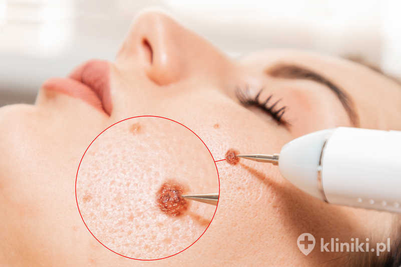 Dermatolog usuwający znamię za pomocą profesjonalnego elektrokoagulatora Dermatolog usuwający znamię za pomocą profesjonalnego elektrokoagulatora