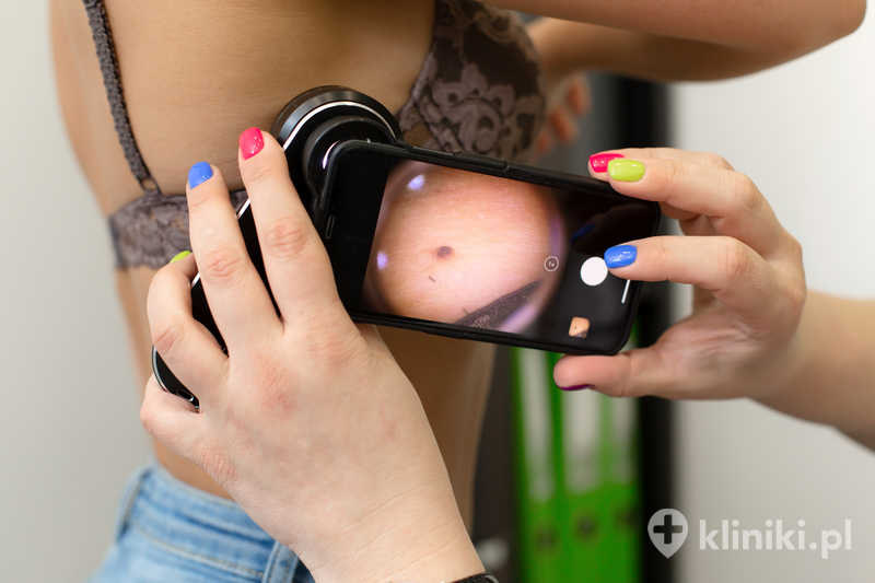 Lekarz dermatolog bada znamiona i pieprzyki pacjenta za pomocą specjalistycznego dermatoskopu Lekarz dermatolog bada znamiona i pieprzyki pacjenta za pomocą specjalistycznego dermatoskopu