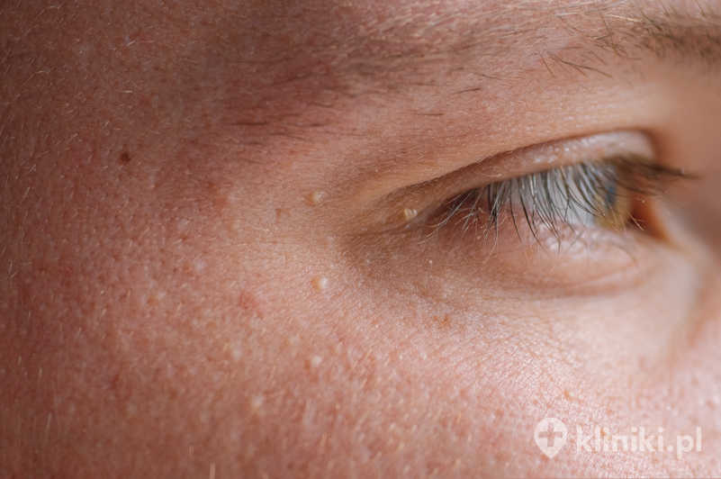 Prosaki (milia) – drobne grudki na skórze wokół oczu