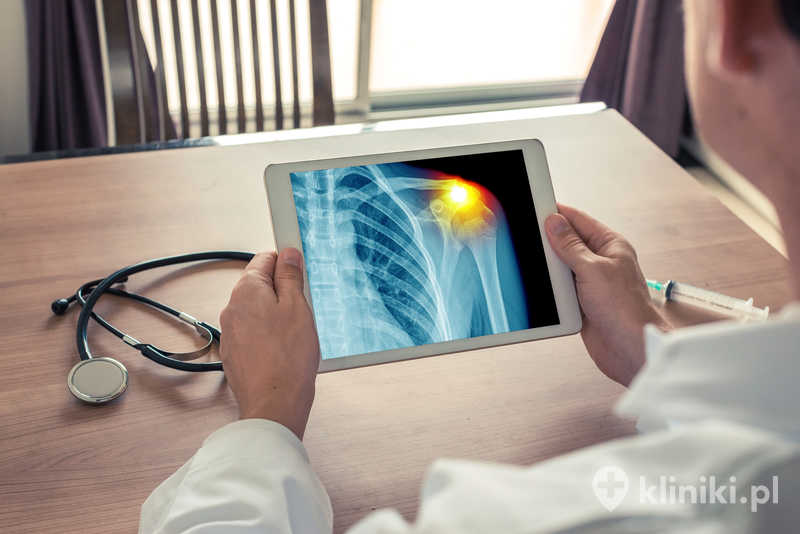 Rekonstrukcja artroskopowa barku wymaga odpowiednio prowadzonej rehabilitacji, która odgrywa kluczową rolę w odzyskaniu pełnego zakresu ruchu oraz siły mięśniowej