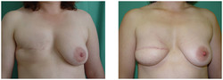 Rekonstrukcja piersi płatem z pleców (LD) przed i po zabiegu