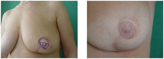 Rekonstrukcje piersi przed i po zabiegu